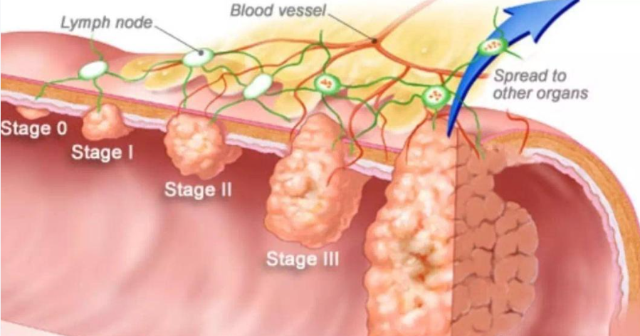 不手術、不放化療也能抗癌，腫瘤免疫治療到底是咩？一篇睇懂