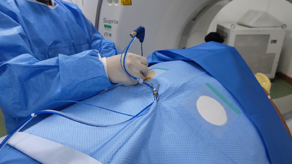 肝癌治療：消融與冷凍療法精準消滅癌細胞