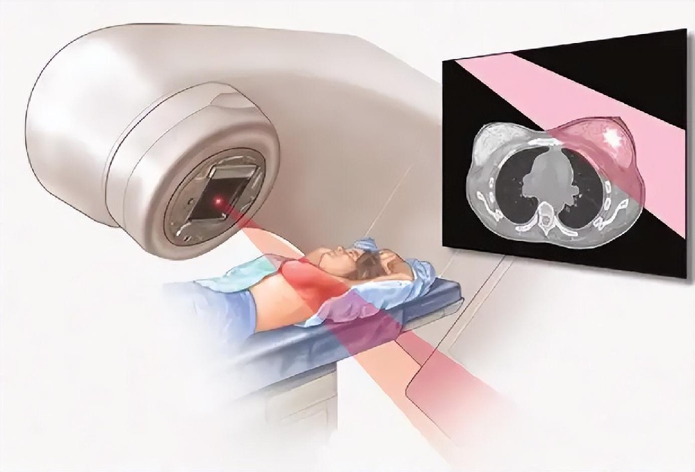 早期三陰性乳腺癌不做手術的方案,也能實現5年不復發