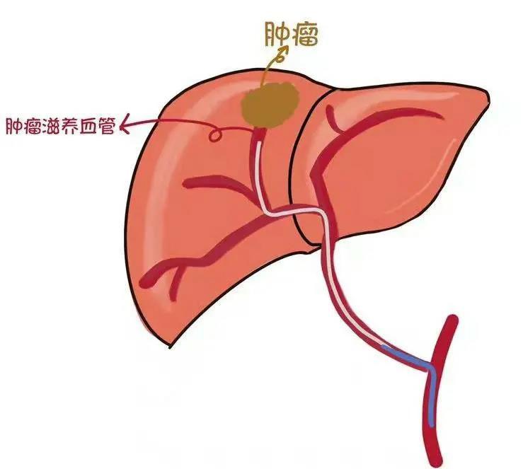 肝動脈灌註化療：晚期肝癌患者的新希望之光