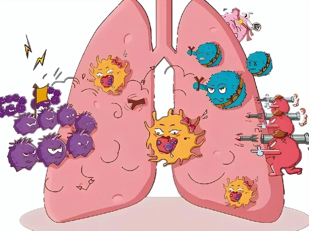 影響肺鱗癌痊癒率的因素有哪些?