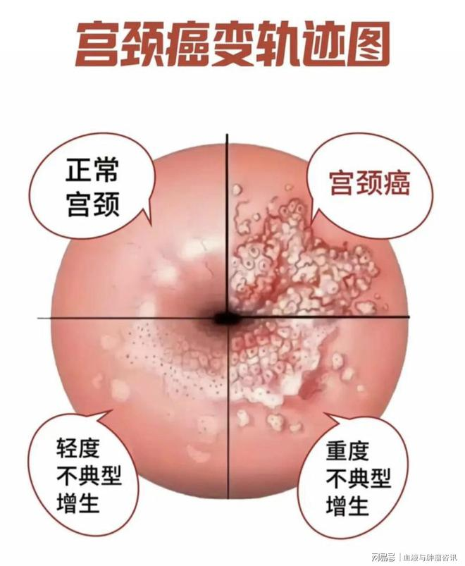 宮頸癌前病變是什麼？早期宮頸癌如何治療？