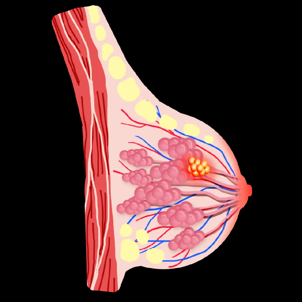 乳腺癌的治療方式：個性化、綜合化與科技化的融合