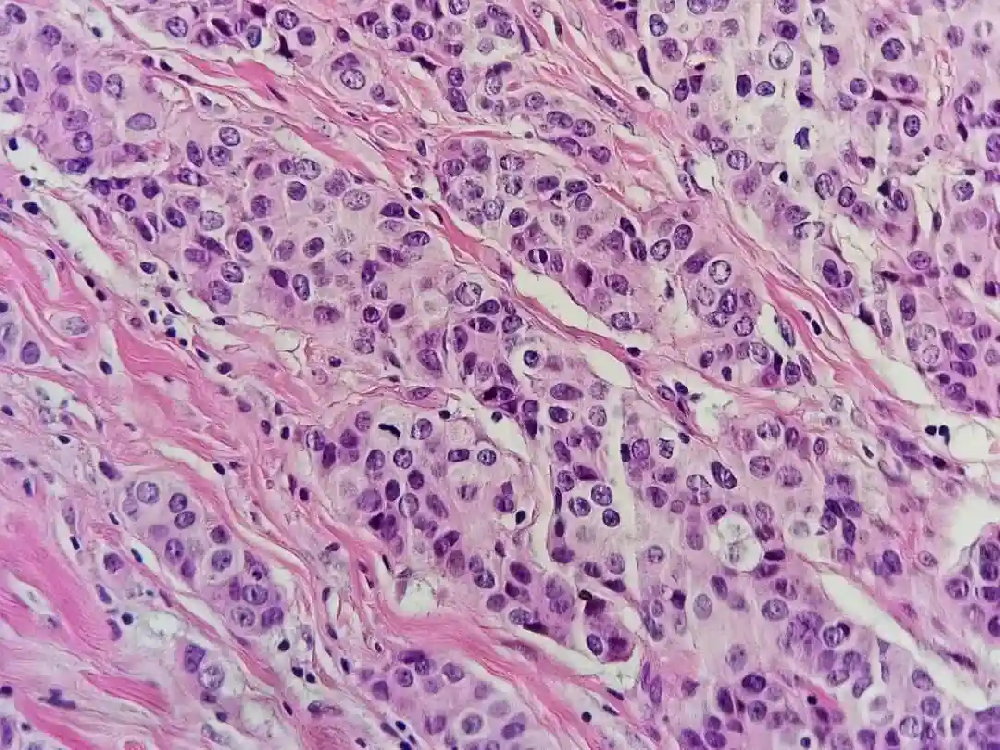 乳腺癌病理報告解讀：ER、PR、Ki-67、HER-2 等指標全解析