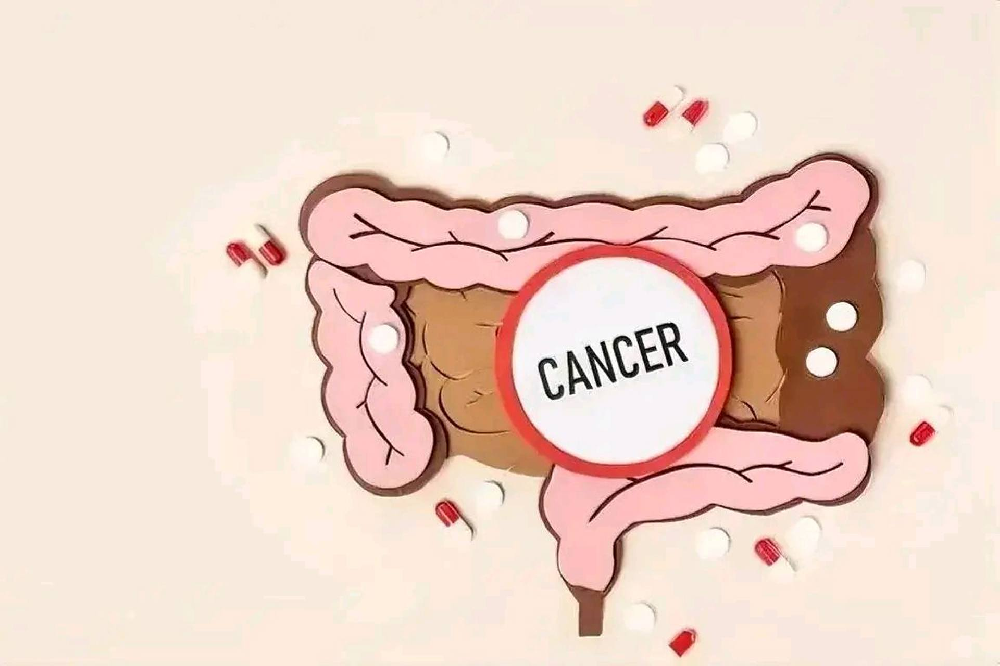 “腸道殺手” 悄無聲息！結腸癌的類型、分期、症狀與治療全攻略