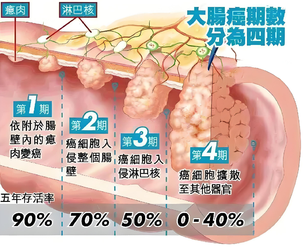 科學應對結直腸癌：七步診療指南助您打贏抗癌之戰
