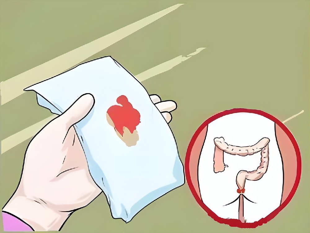 別把直腸癌當腸炎！3種易混淆疾病,一文說清