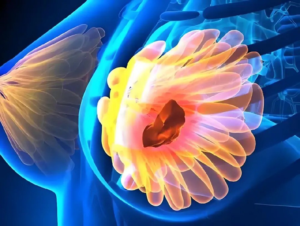 為何手術成功也會復發？難道癌症病灶有殘留？這 3 個隱形原因比殘留更危險！