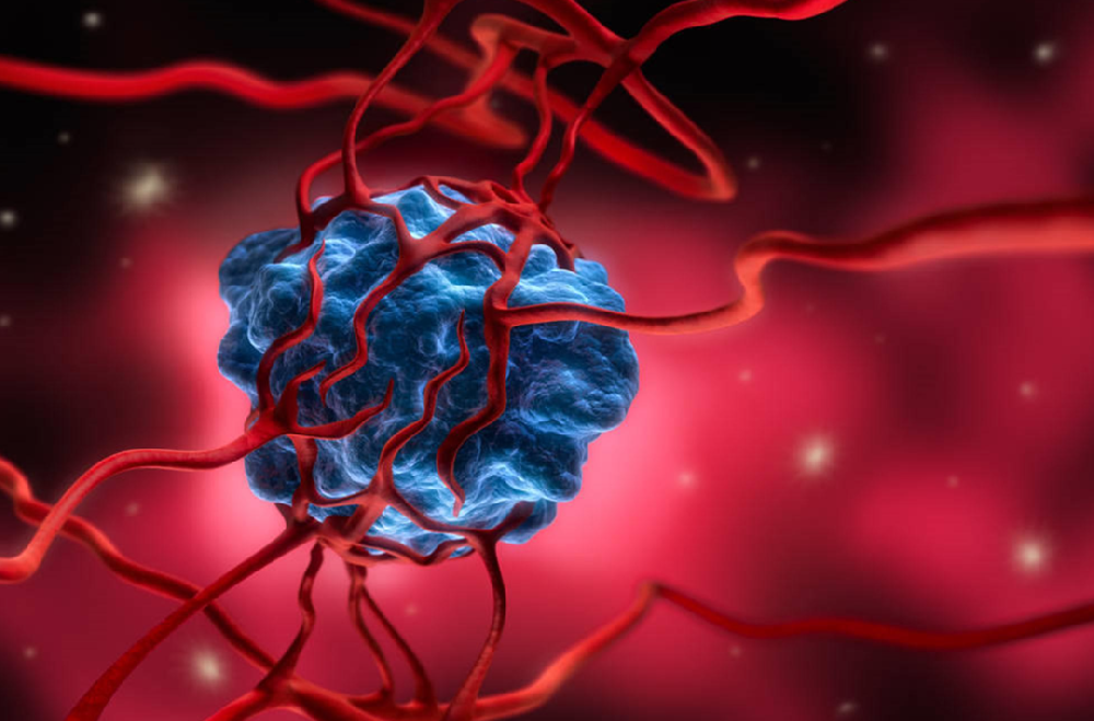 腫瘤突然惡化非偶然，近9成患者忽略了這3個細節！