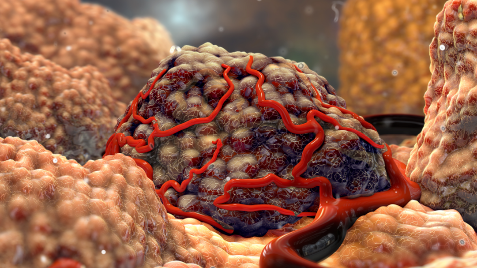 腫瘤沒轉移就萬事大吉？這3類人必須警惕，放化療不能省！