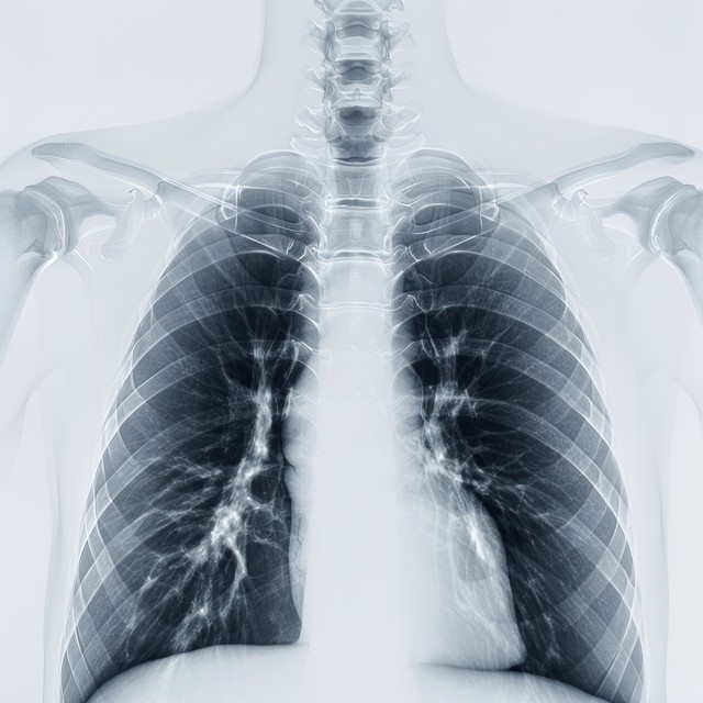 當地醫生说是炎症，她卻坐立不安…自己的直覺，揪出早期肺癌！