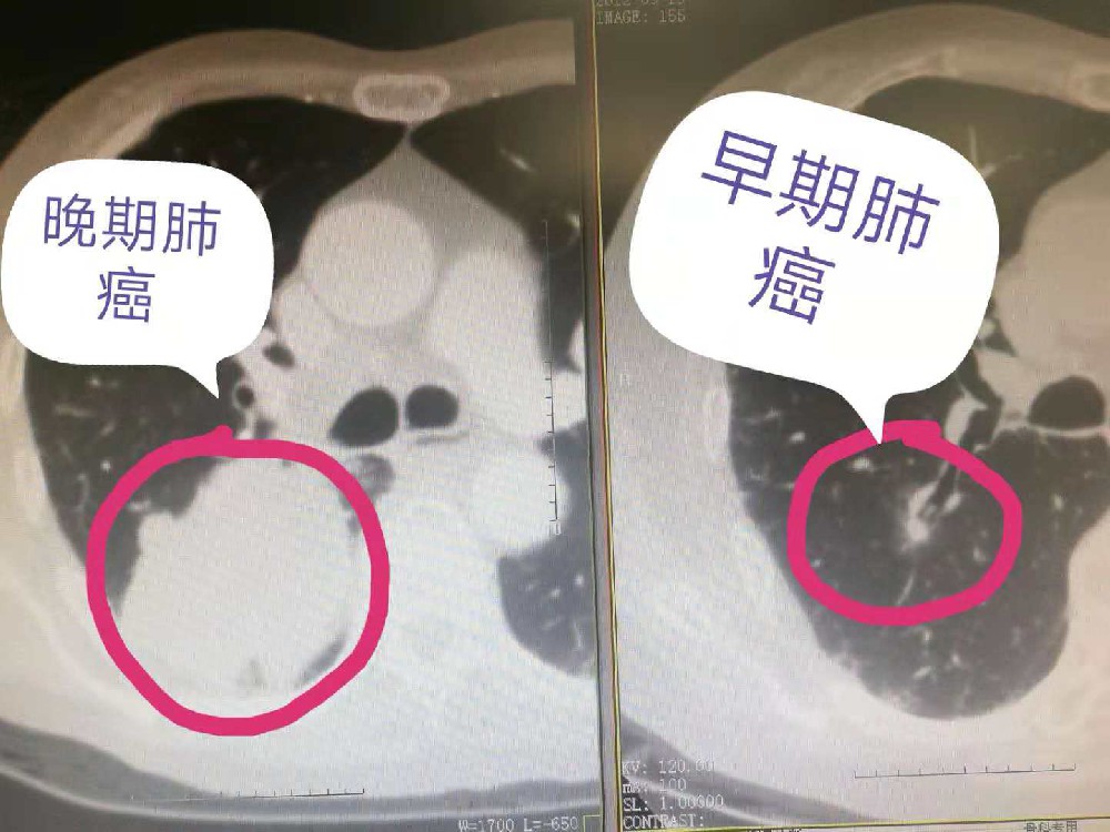 淋巴結轉移的肺腺癌患者,術後可放療的適用標準