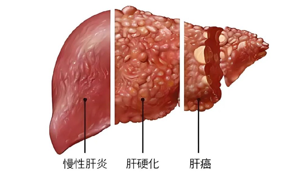 不可切除肝內膽管癌：局部治療的潛在價值探索