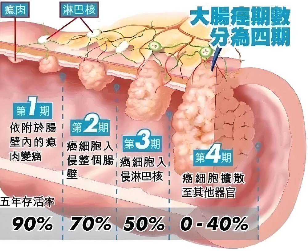 結腸癌的早中晚期診斷及相關知識